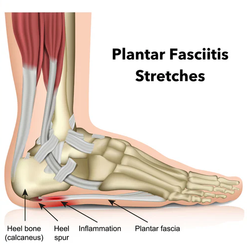 plantar fasciitis treatment malaysia
