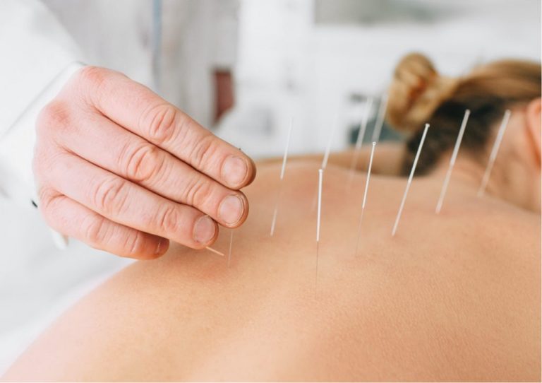 Dry needling session as part of back pain treatment in KL to relieve muscle tension and lower back issues