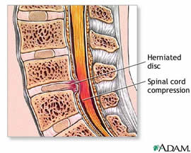 Herniated disc causing spinal cord compression, a common cause of lower back pain treated in Malaysia