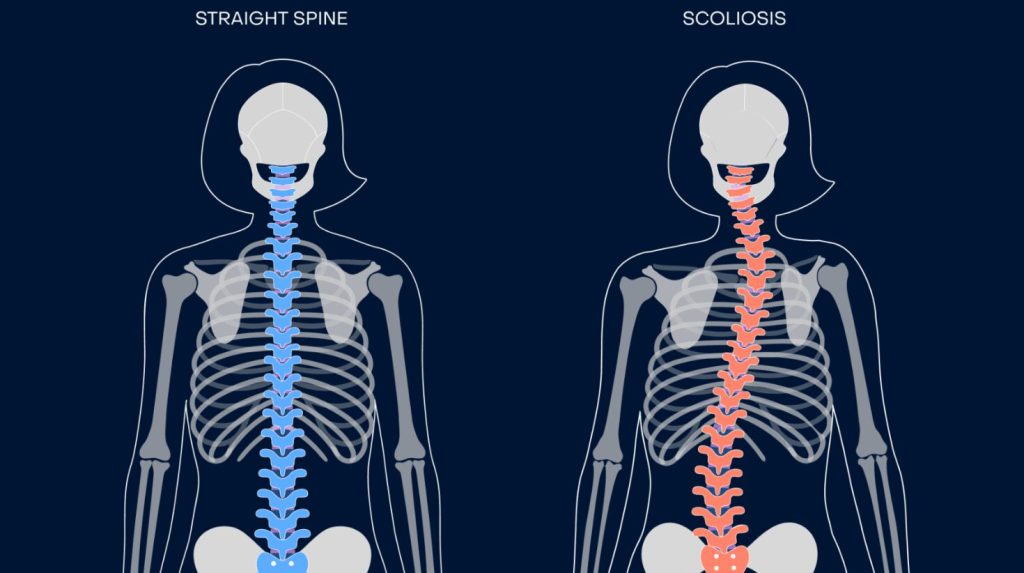 an image of a person with scoliosis