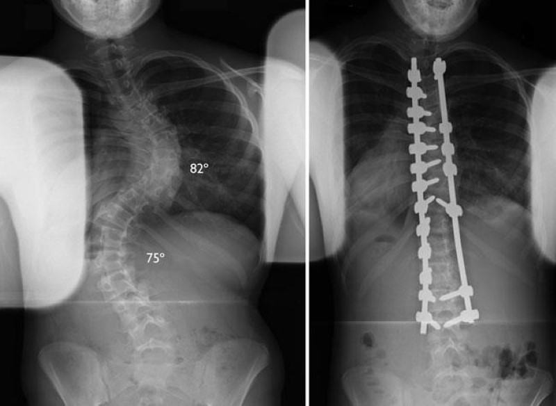 scoliosis surgery