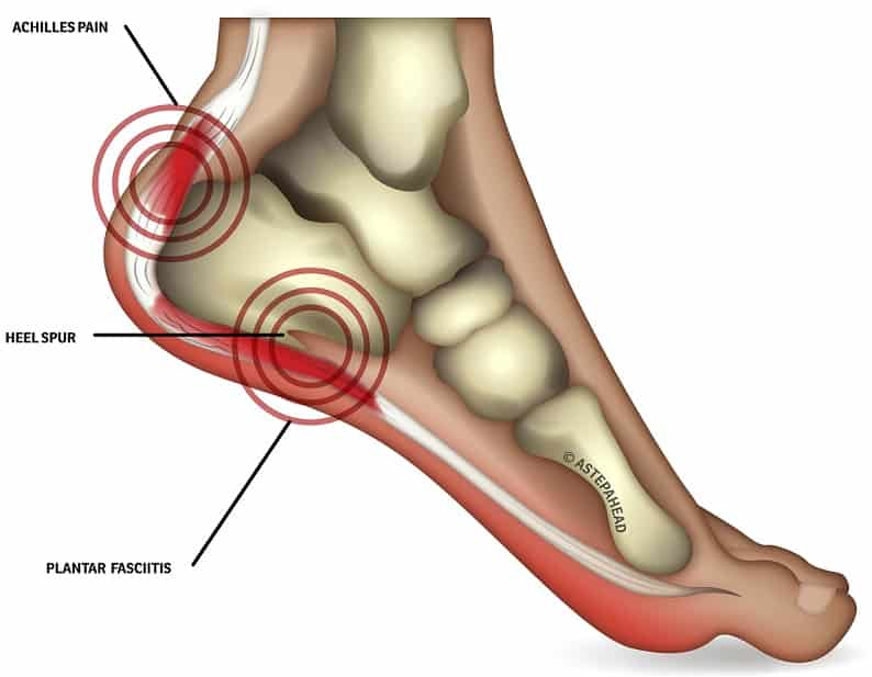 heel pain explain
